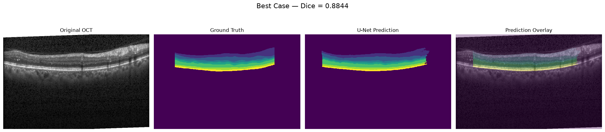 Representative OCT retinal-layer segmentation case: original scan, ground truth, prediction, and overlay