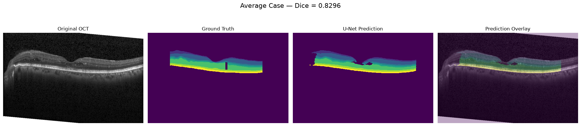 Best validation case for OCT retinal-layer segmentation