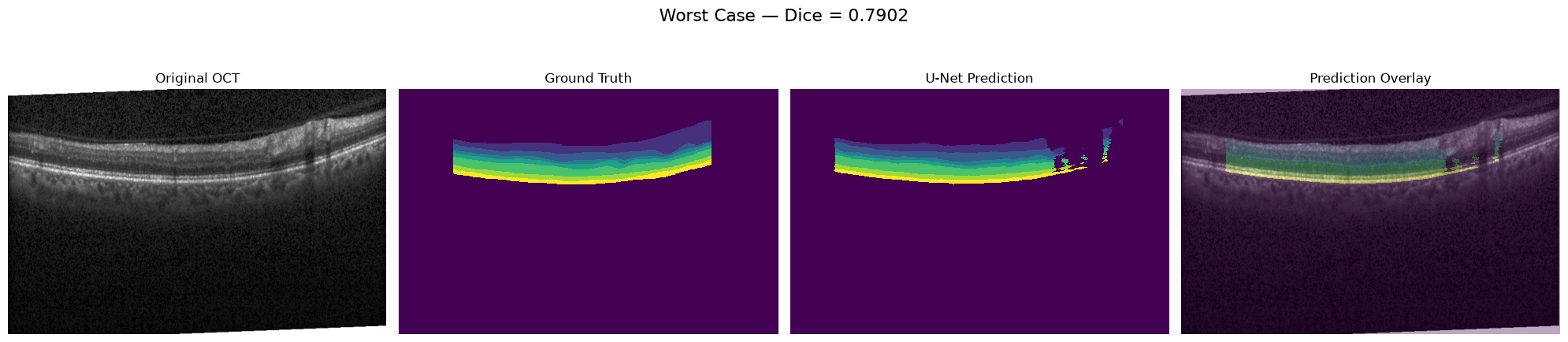 Worst validation case for OCT retinal-layer segmentation