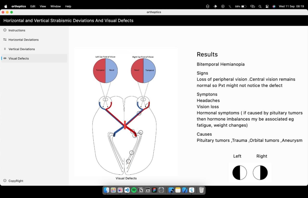 Orthoptics Simulation Software interface showing strabismus conditions and visual exercises